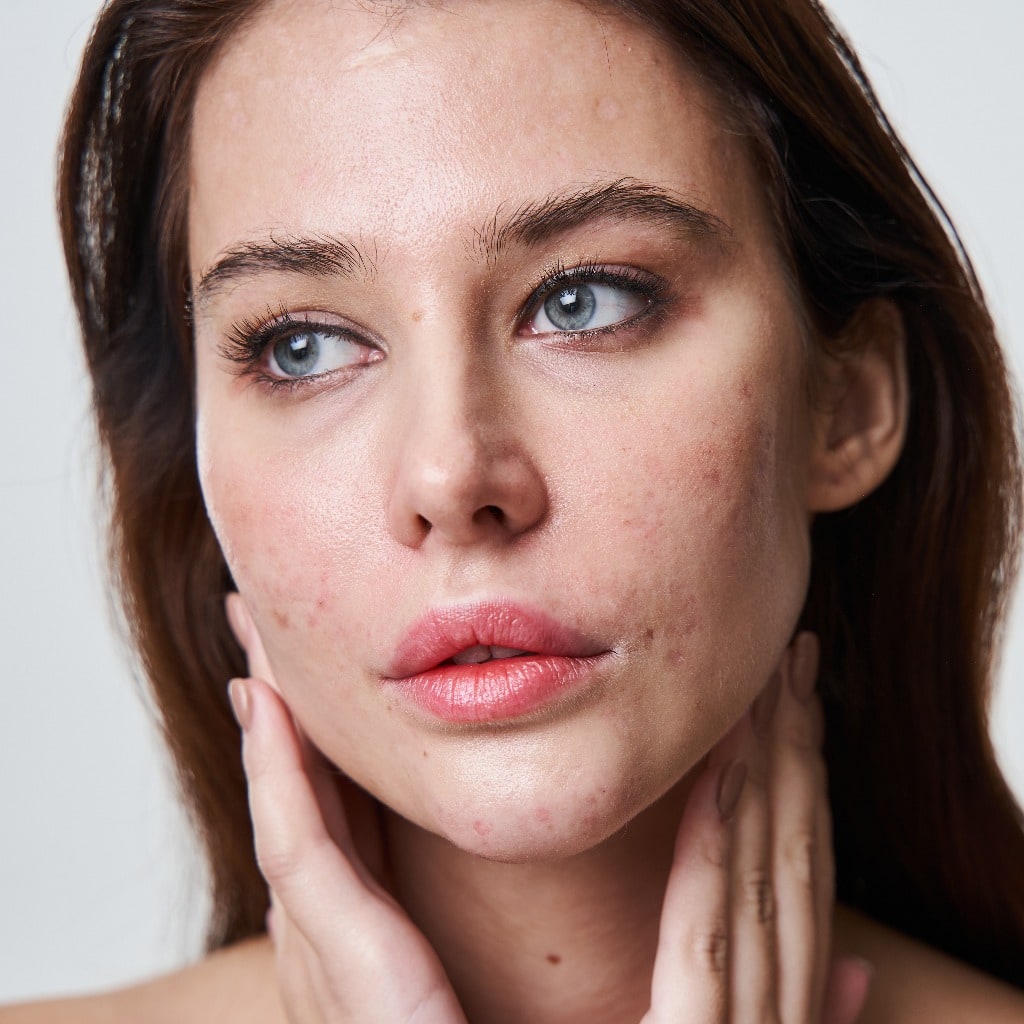 Charming young lady with acne face looking away with pensive expression